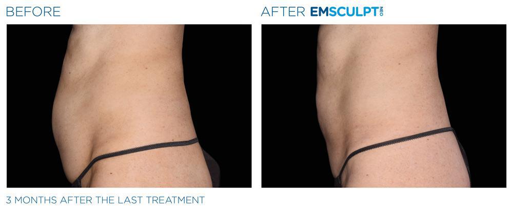 EMSculpt Neo Stomach Results