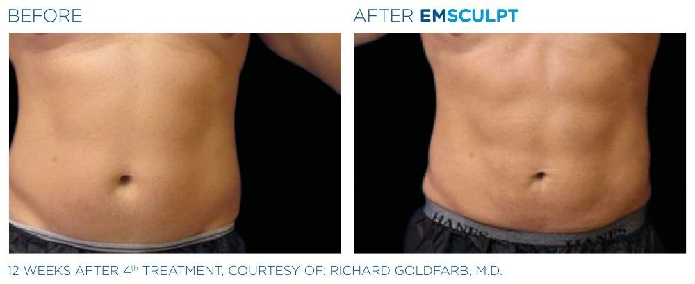 EMSculpt Neo Abs Results