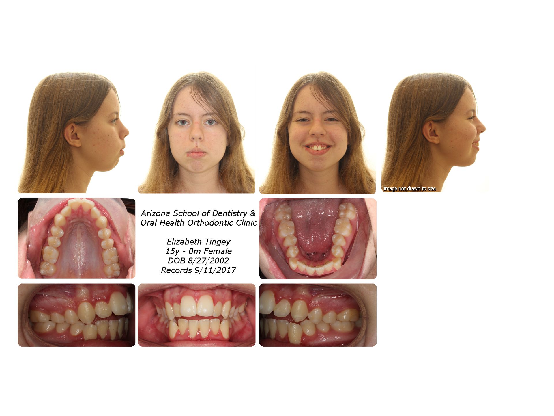 Underbite treatment complete — final facial and intraoral photographs showing corrected Class I bite after orthodontic treatment