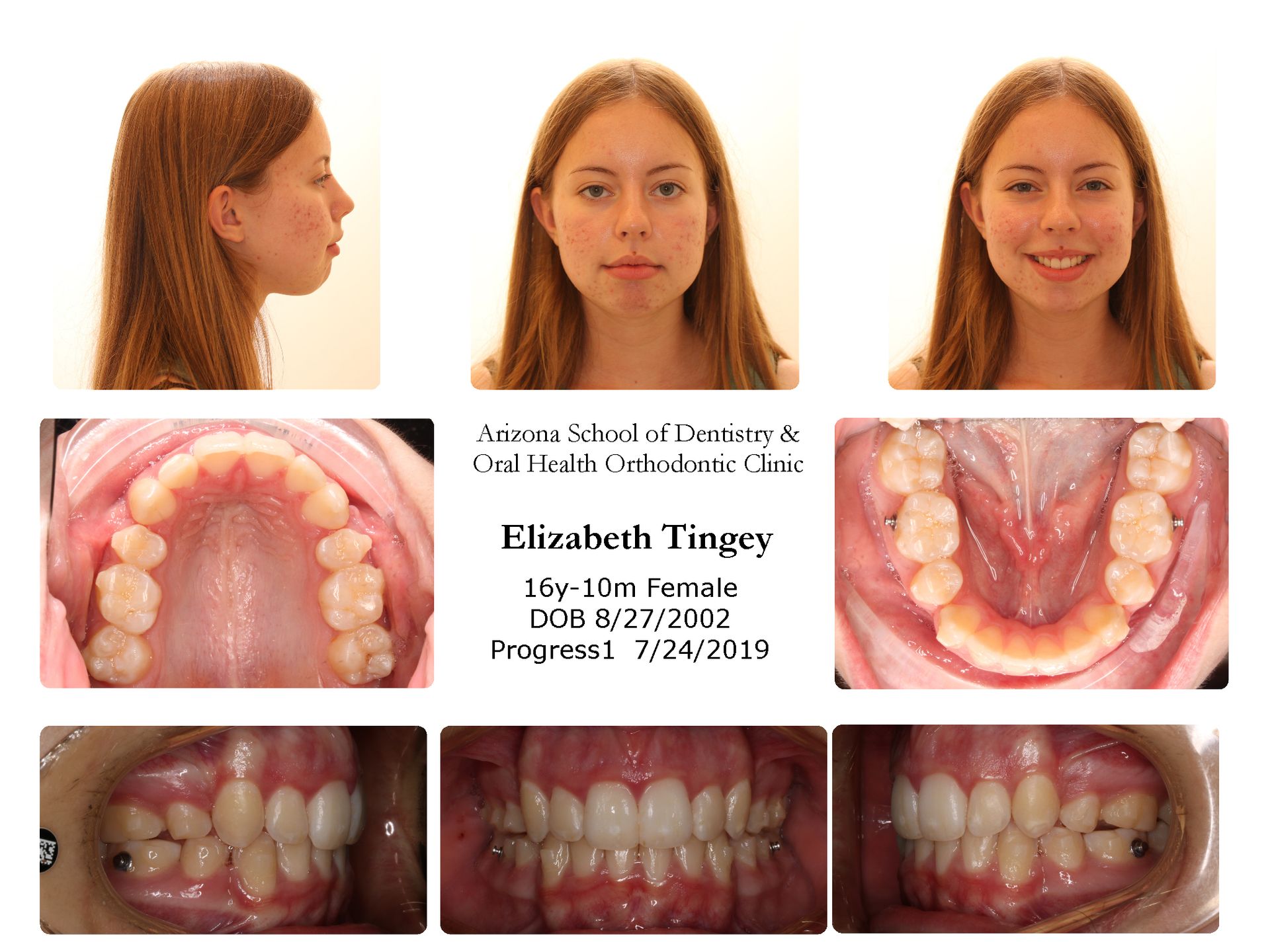 Active underbite treatment with braces — intraoral progress photographs showing Class III correction in progress with green elastics