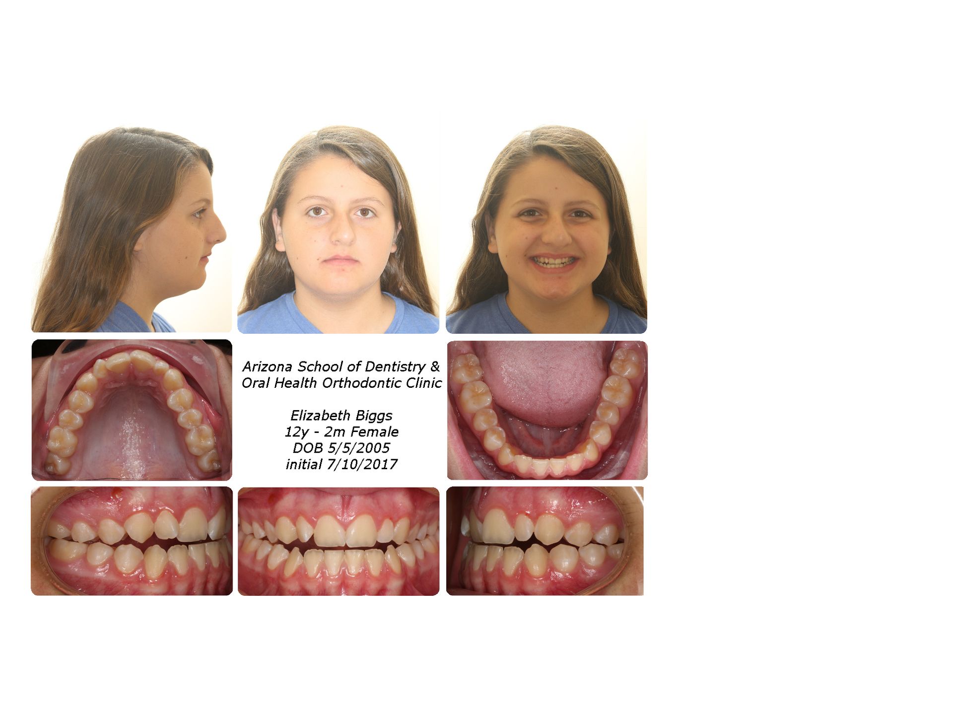 Underbite case — before Invisalign treatment, patient records showing Class III bite