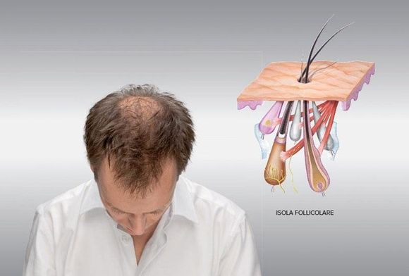 rappresentazione consulenze e prodotti per rimediare alla perdita di capelli