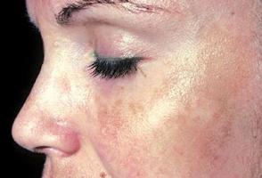 figura del trattamento di macchie e discromie della pelle