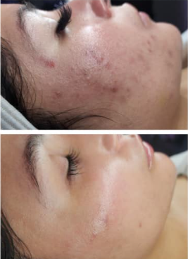 A before and after picture of a woman 's face with acne.