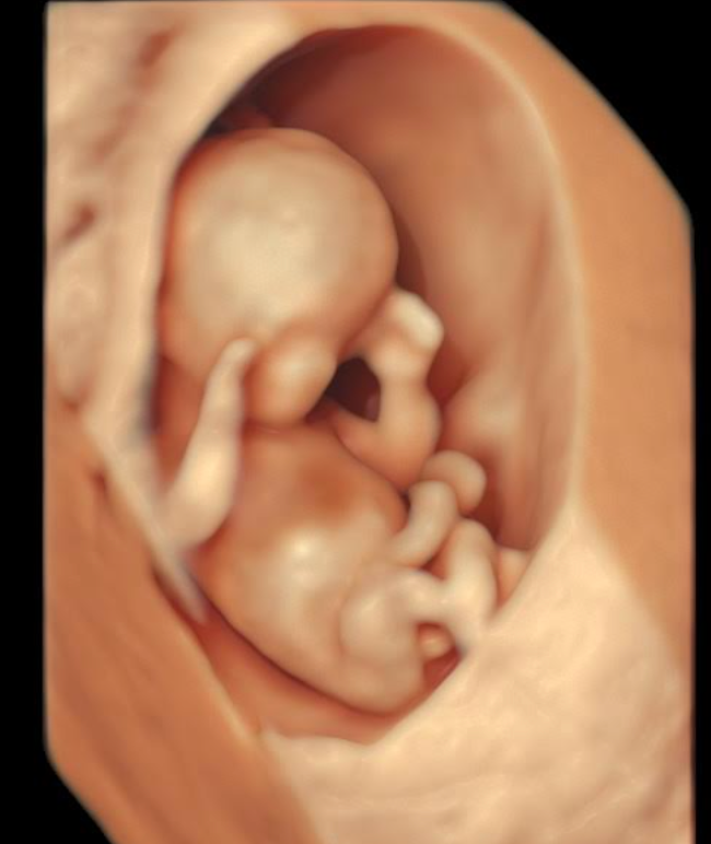 Ecografía 3D de un feto acurrucado en el útero, que muestra la cabeza, las extremidades y el saco amniótico circundante.