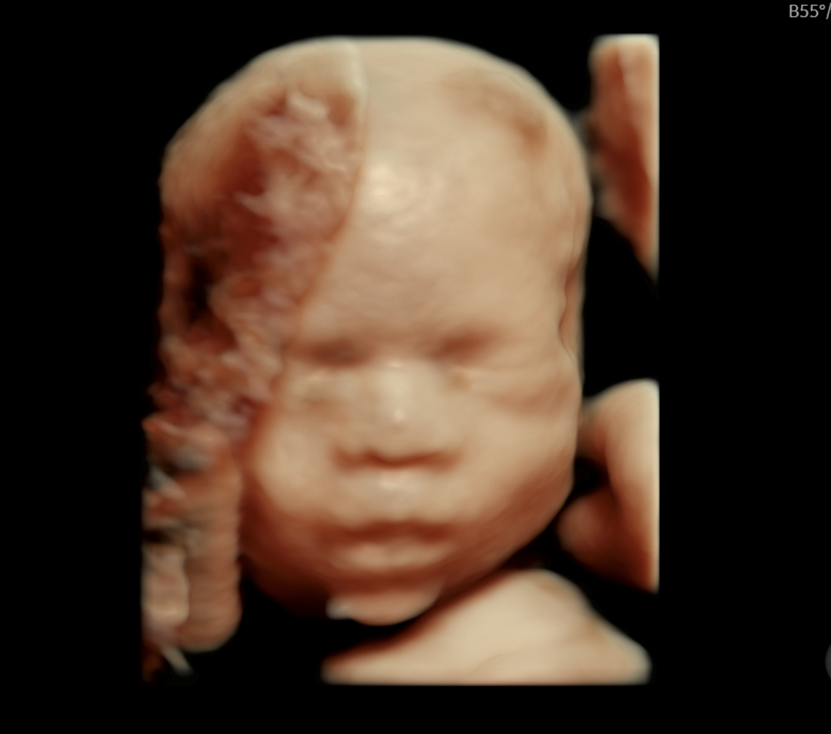 Ecografía 3D del rostro de un feto, con la cara lisa y los ojos cerrados, en tonos marrones.