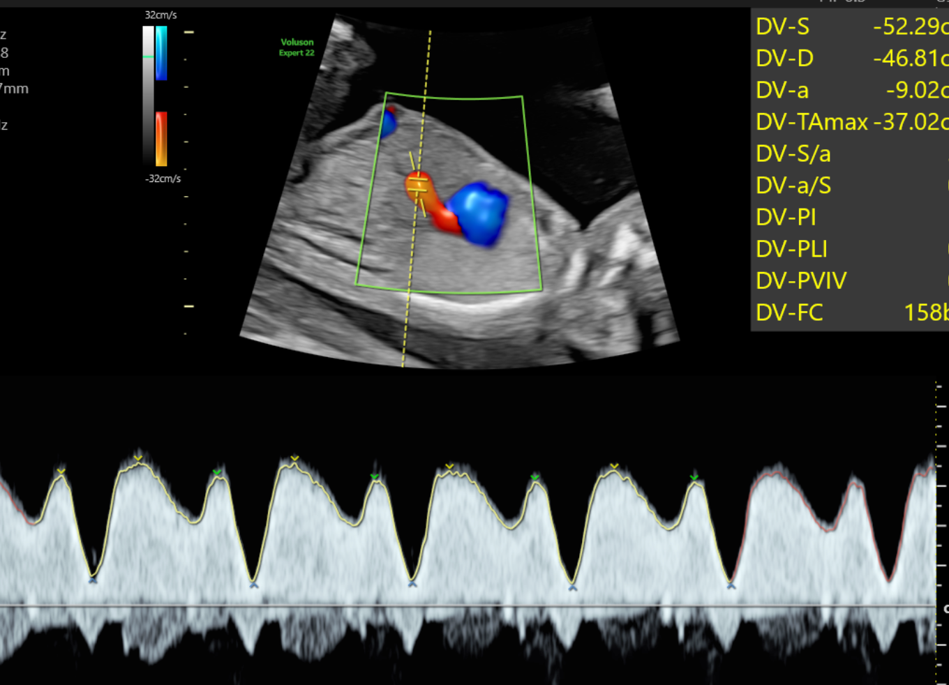 Ecografía fetal con análisis de flujo Doppler de un conducto venoso
