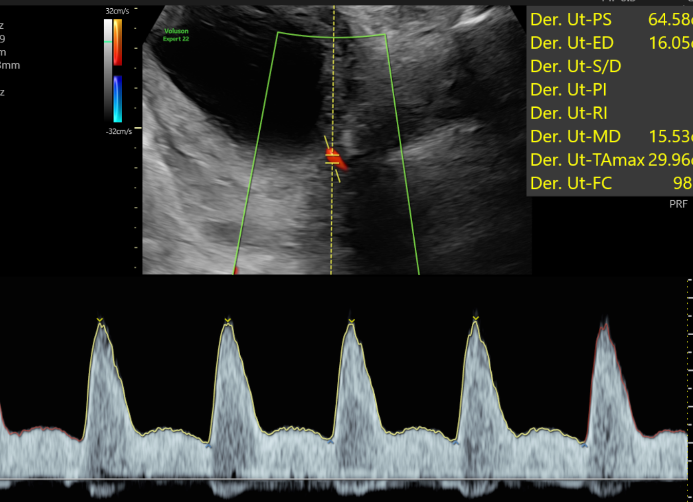 Doppler. de la Arteria Uterina. Gráfico de forma de onda del flujo sanguíneo 