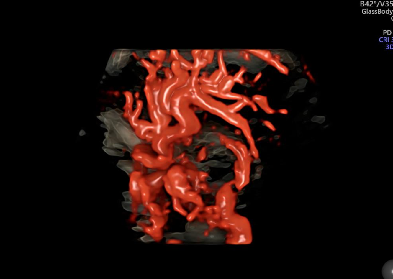Representación Doppler 3D de vasos sanguíneos a nivel del cuerpo calloso 