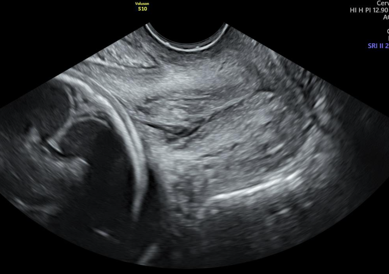 Ecografía del útero de una embarazada, que muestra las estructuras fetales.