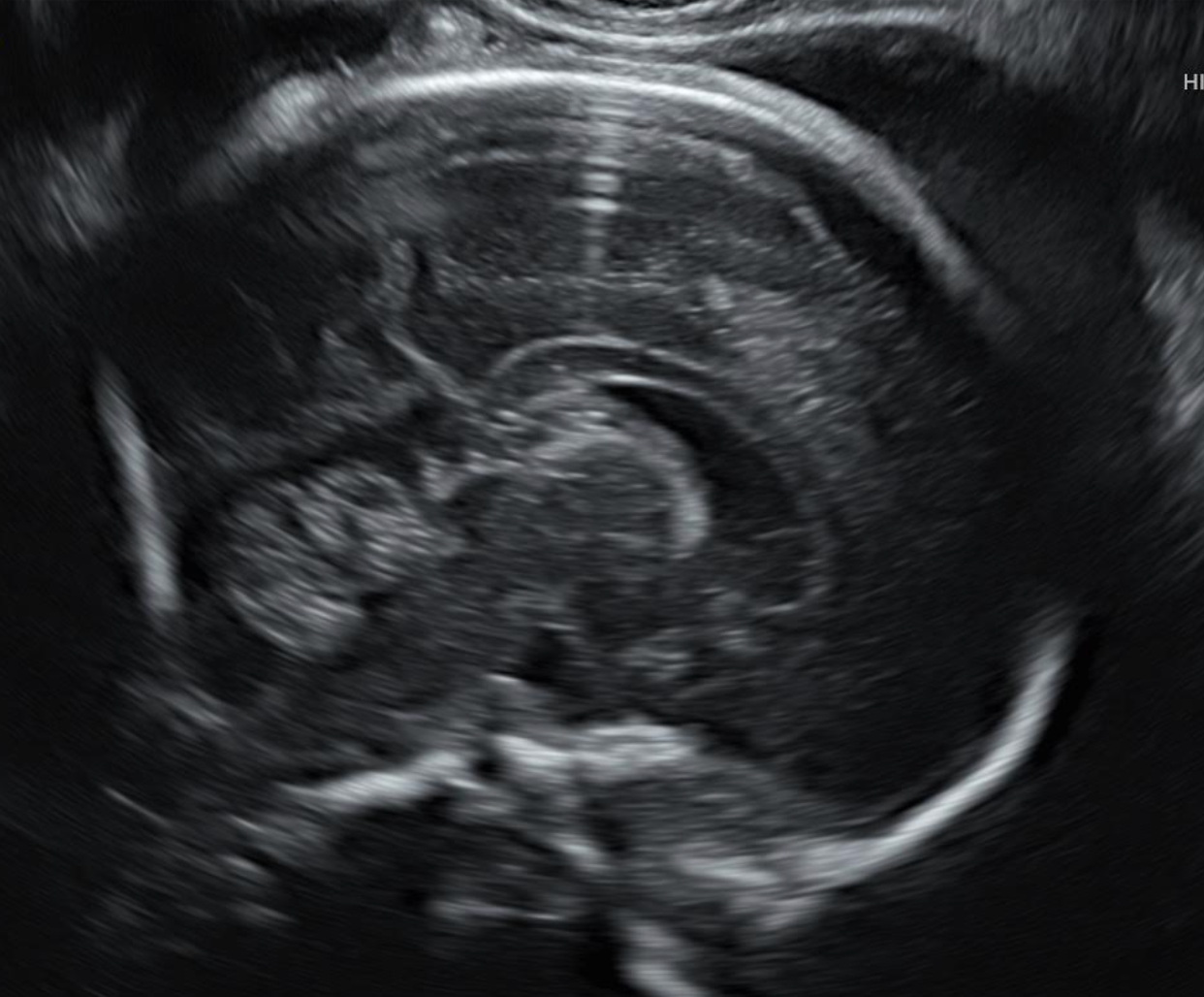 Ecografía fetal, que muestra la cabeza y el cerebro de un feto en escala de grises.