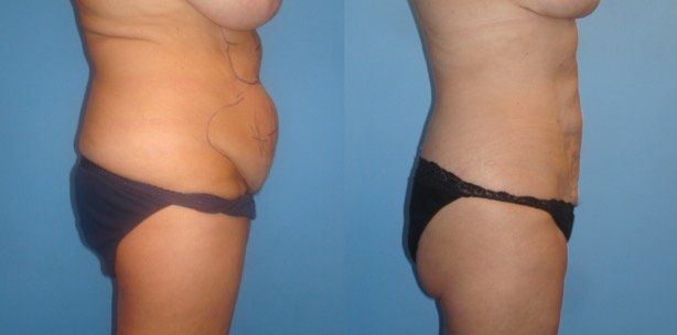 BodyTite - Before & After - Abdomen
