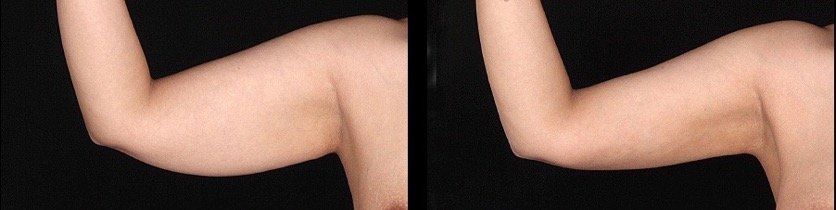 BodyTite - Before & After - Arm