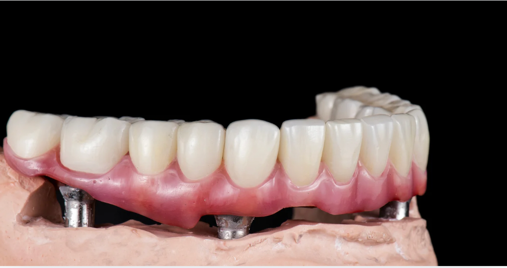 Are There Alternatives to All-on-4 Dental Implants for Full Arch ...