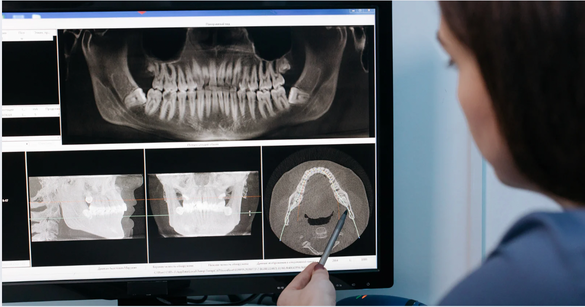 Can Dental Implants Help with Jaw Alignment Issues?