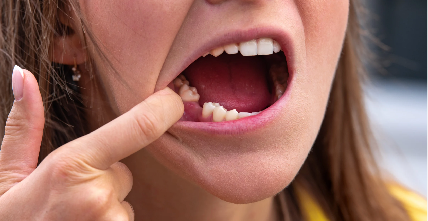 Can Dental Implants Prevent Future Tooth Loss?