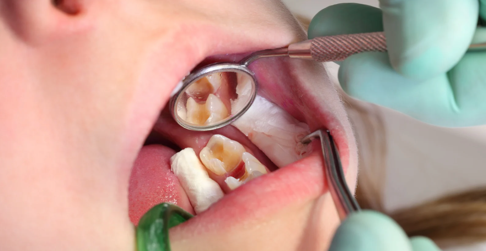 What Are the Best Practices for Preventing Dental Implant Infection?