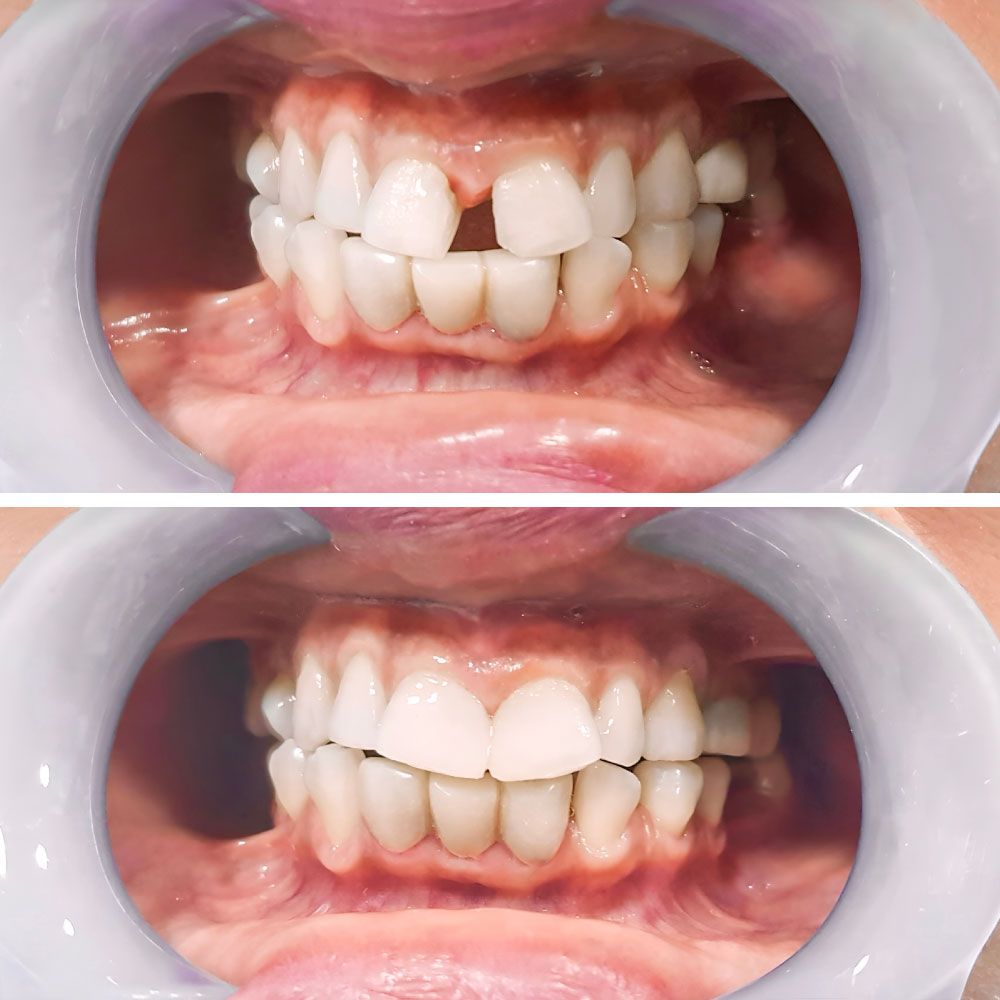 An image showing before and after dental bonding treatment