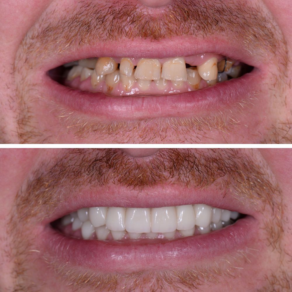An image showing before and after dental implants and crowns