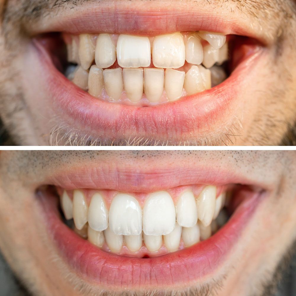An image showing before and after Invisalign® treatment