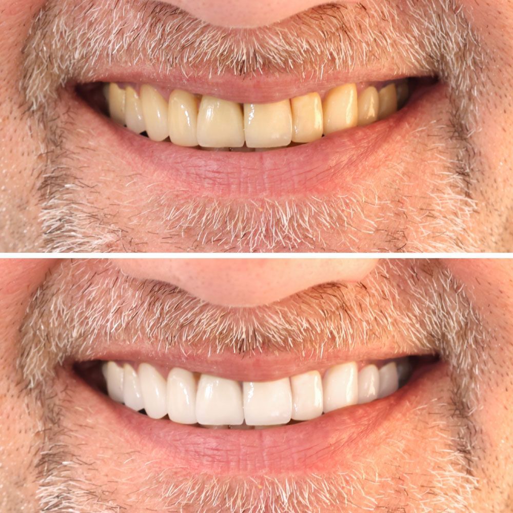 An image showing before and after teeth whitening treatment