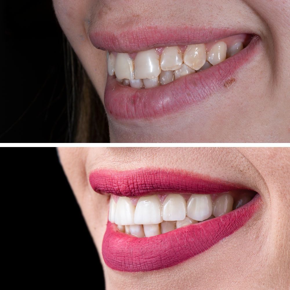 An image showing before and after veneers and crowns