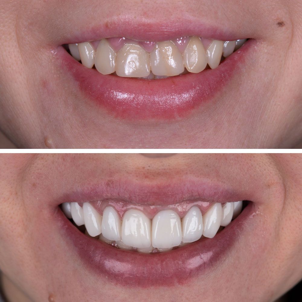An image showing before and after veneers