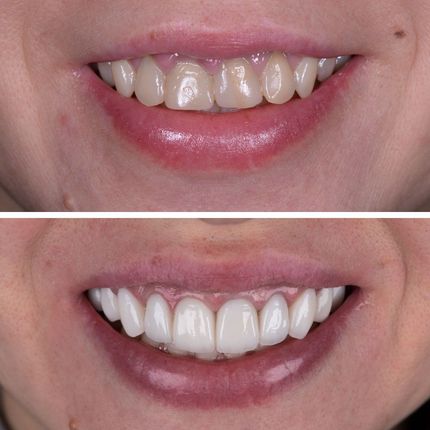 An image showing before and after veneers