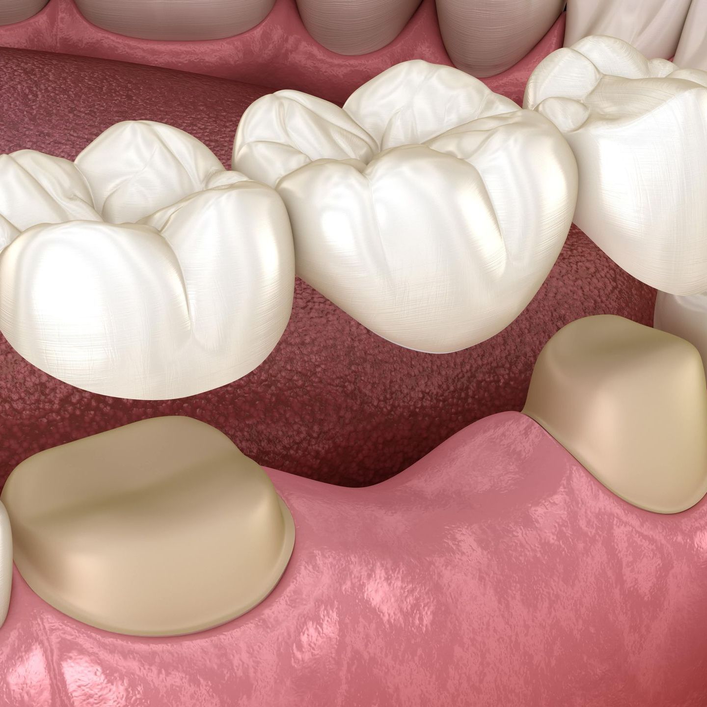 A computer generated image of a dental bridge on top of the missing area of teeth