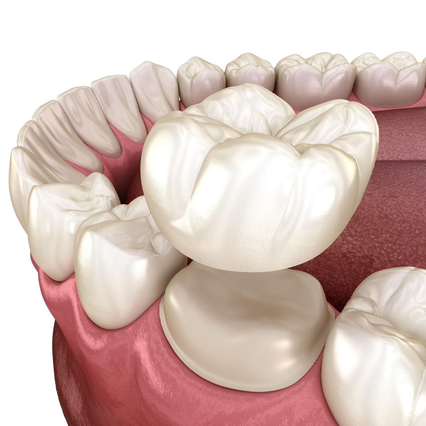 A computer generated image of a dental crown above the tooth