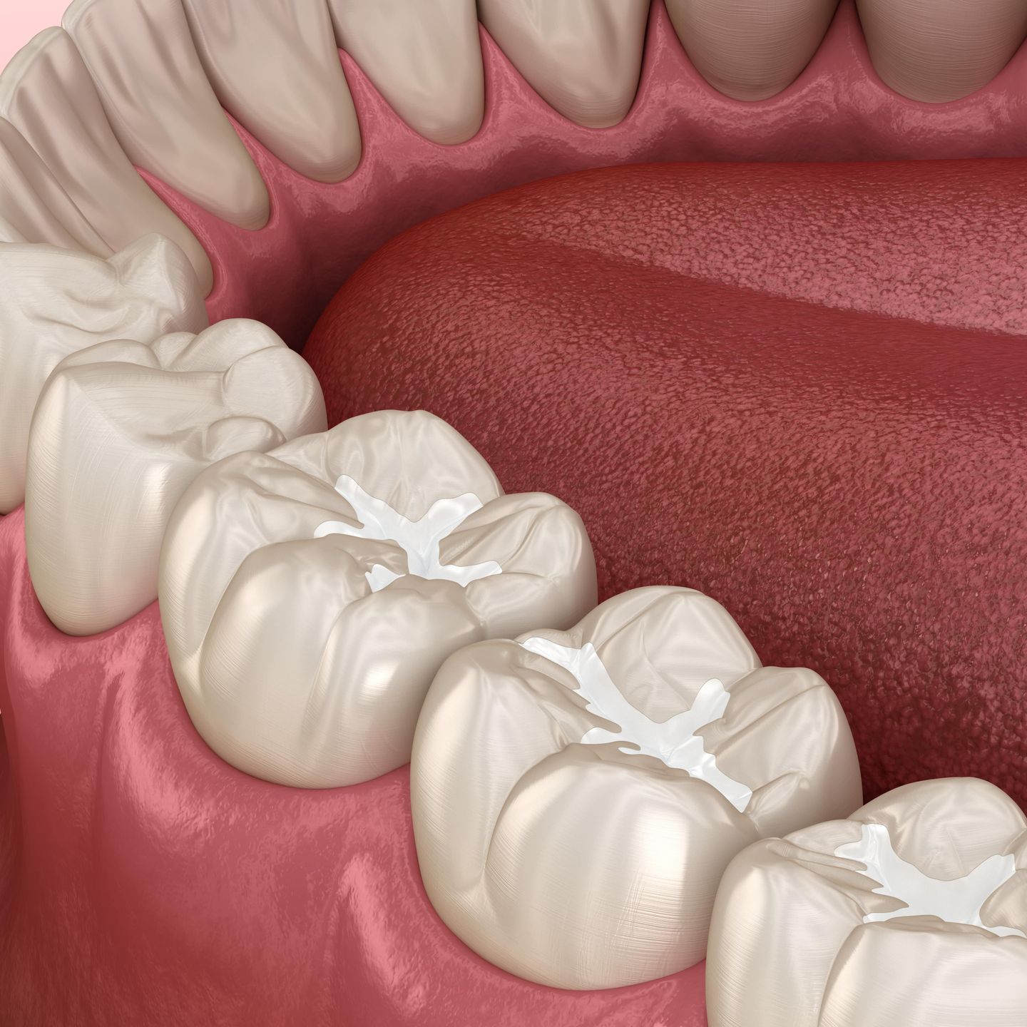 A computer generated of teeth with dental sealants