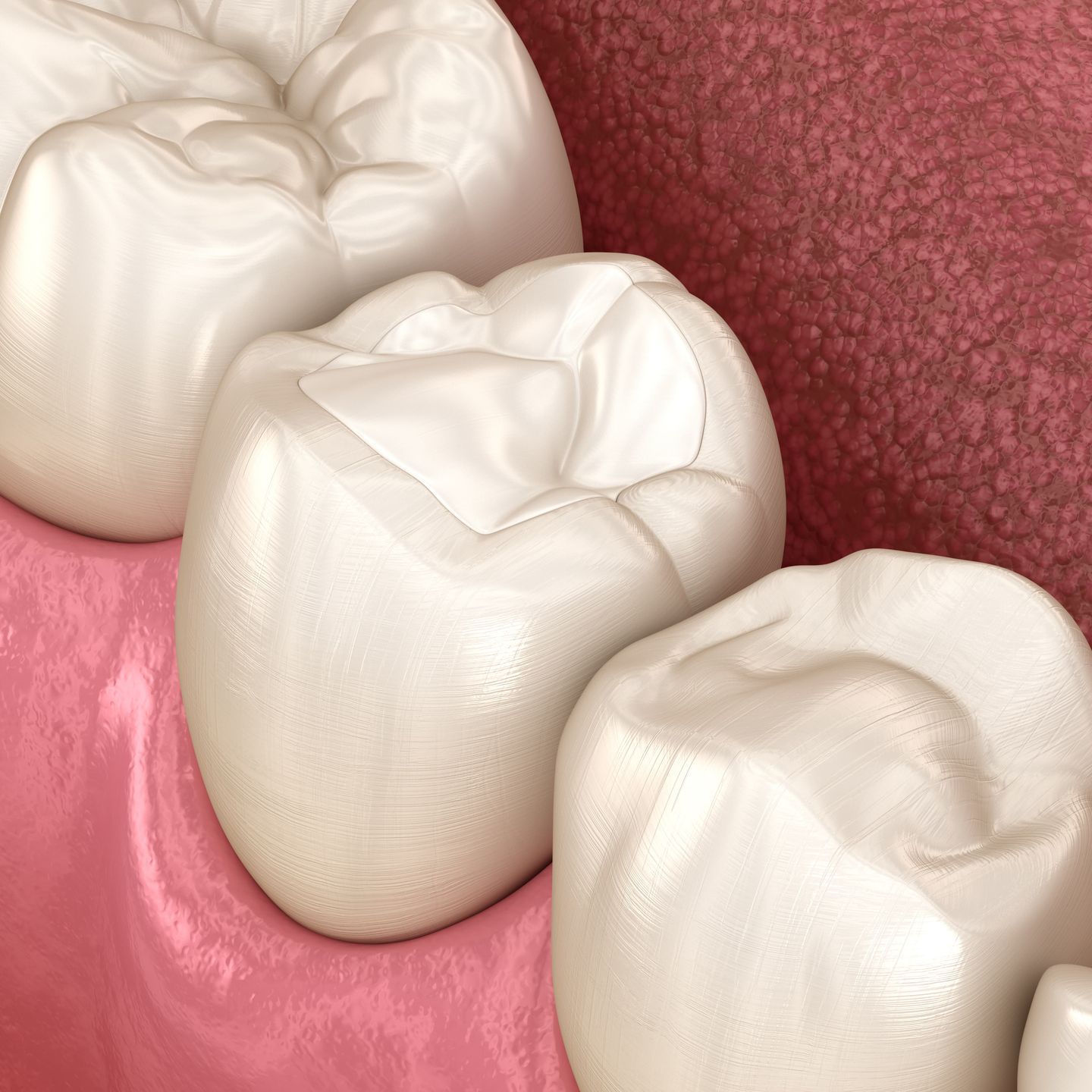 A computer generated image of a tooth filled with a composite filling