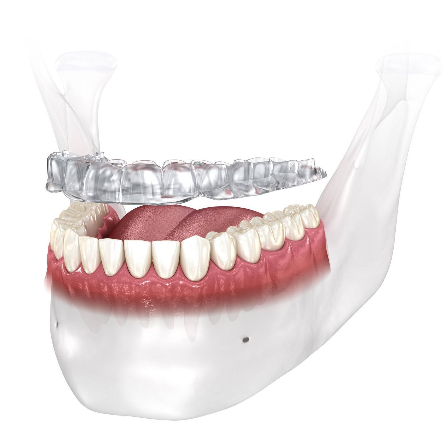 A computer generated image of an oral appliance in the mouth