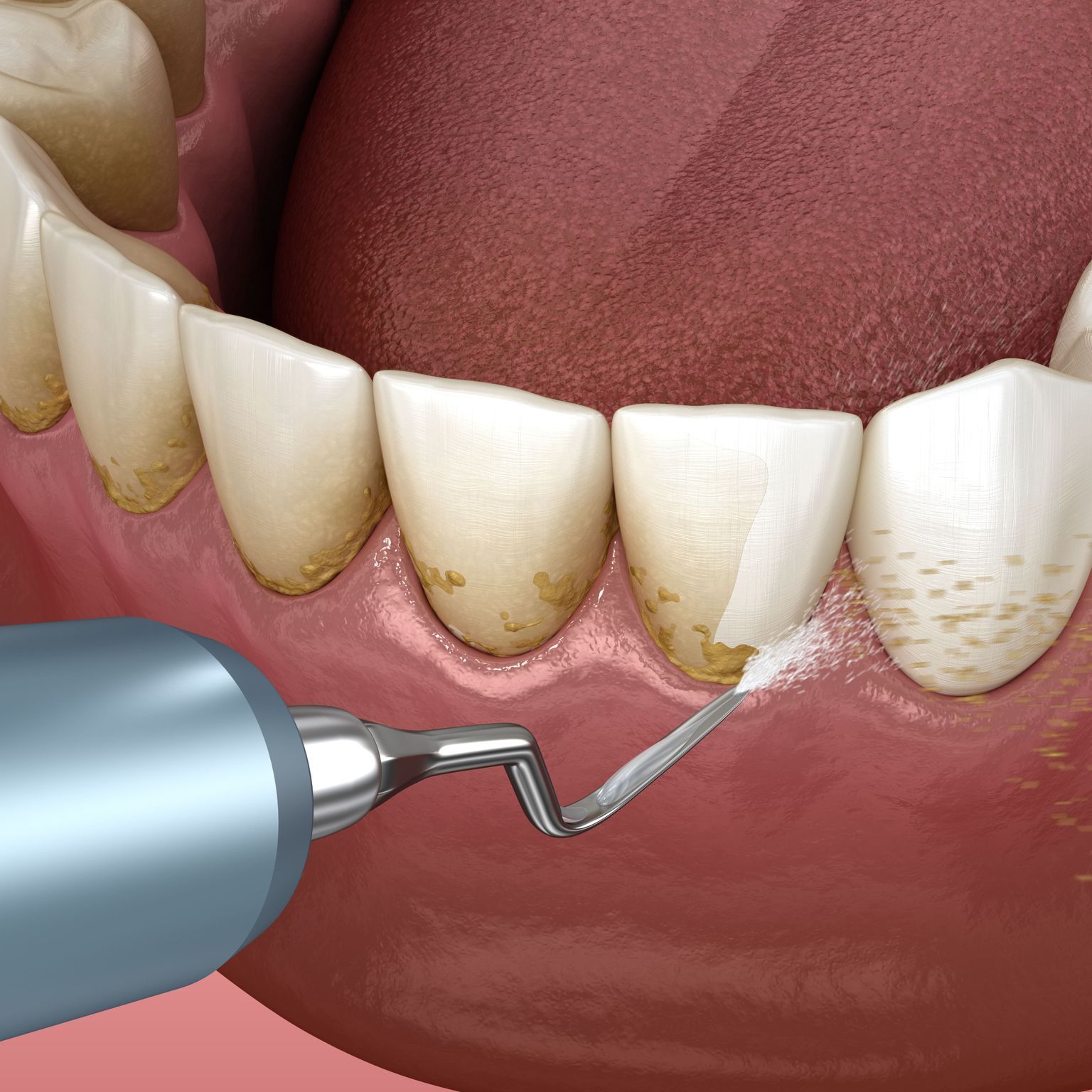 A computer generated image of a dental tool cleaning at the gum line