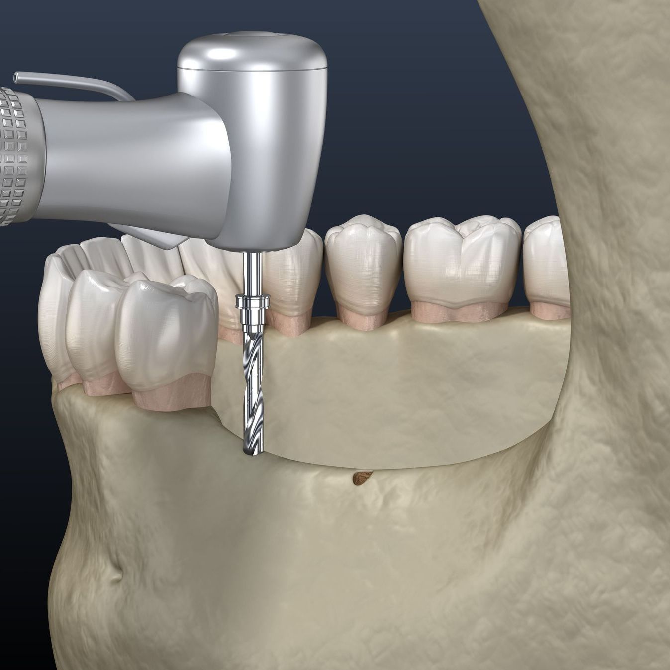 A computer generated image of a jaw bone receiving a ridge augmentation