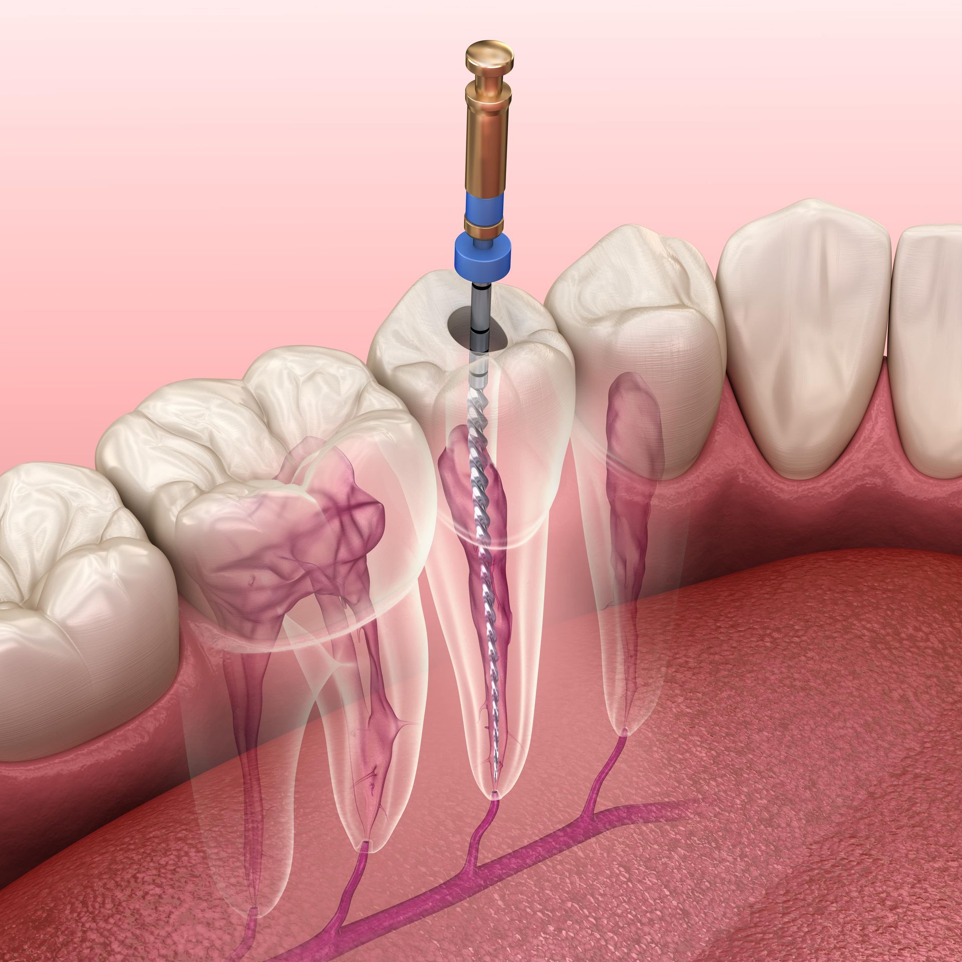 A computer generated image of a tooth root being cleaned with an instrument