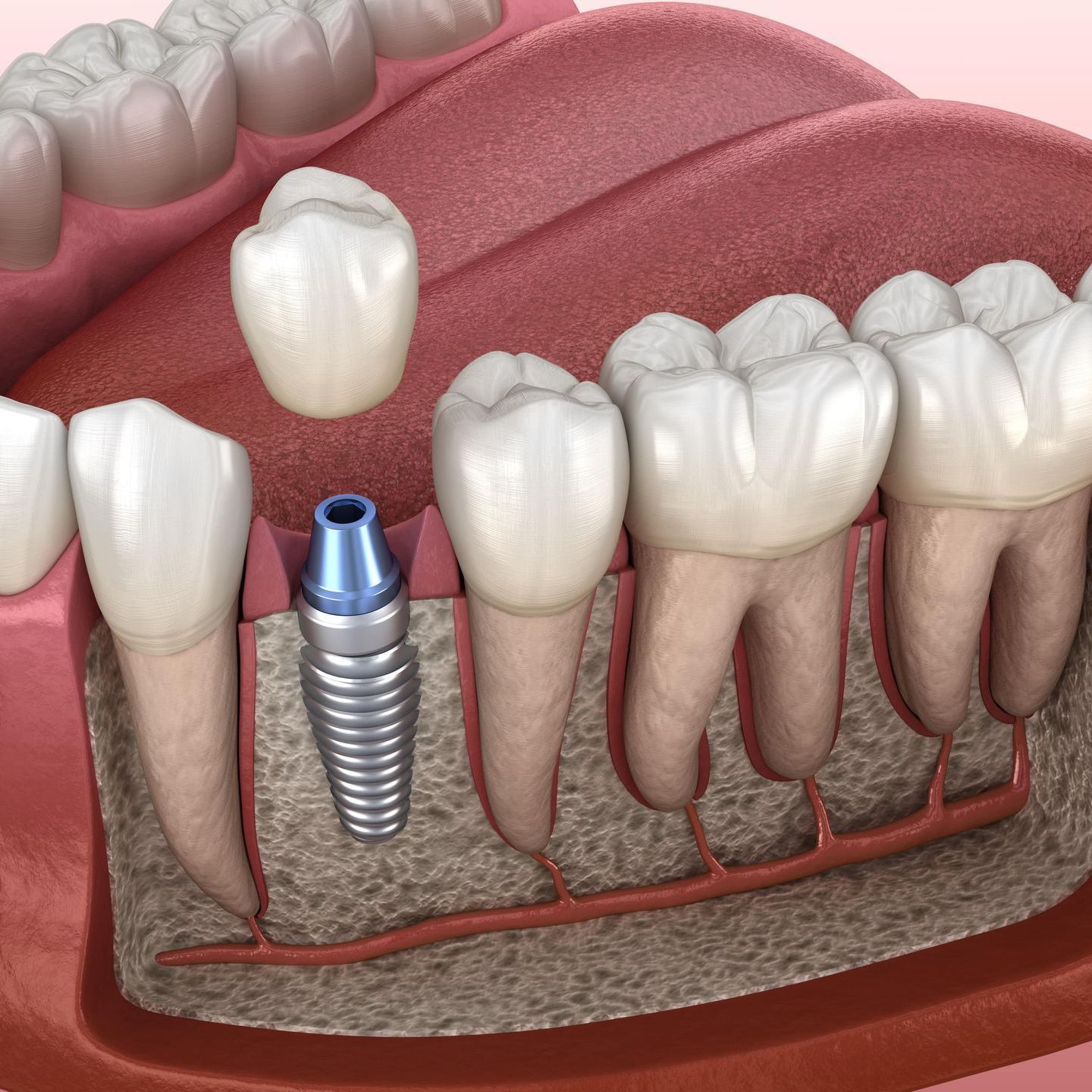 A computer generated image of the inside of the gum showing the dental implant