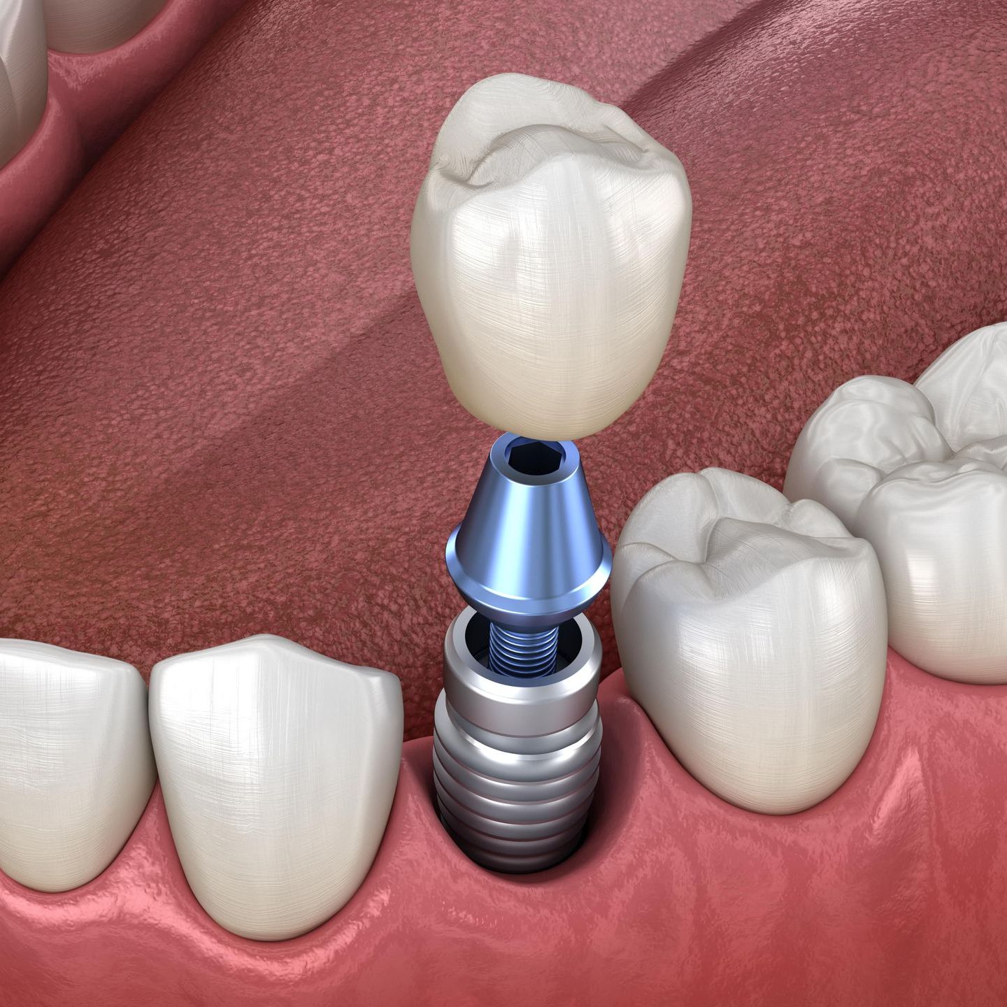 A computer generated image of a single tooth implant showing the implant, abutment, and crown