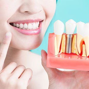 Dental Implant — Dental Restoration in Bonita Springs, FL