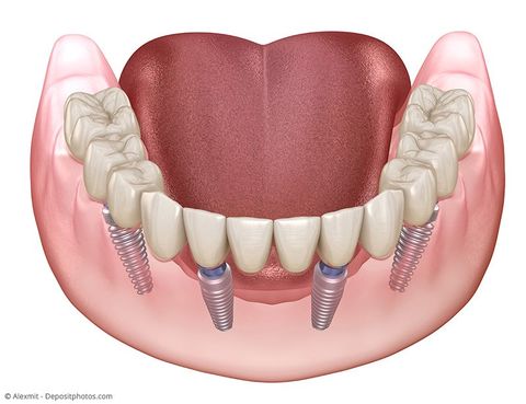 Festsitzende Zahnbrücke auf nur vier Implantaten pro Kiefer