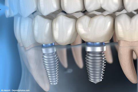 Ersatz von Backenzähne mit zwei Implantaten und einer darauf befestigten Zahnbrücke. Die eigenen Zähne bleiben unbeschädigt.