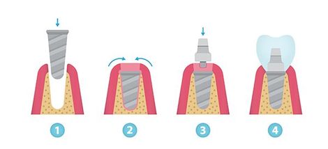 Die einzelnen Schritte einer zweiphasigen Implantation mit zweiteiligen Implantaten