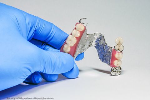 Herausnehmbare Teilprothese, für deren Halt mit sog. Teleskopkronen eigene Zähne beschliffen werden müssen