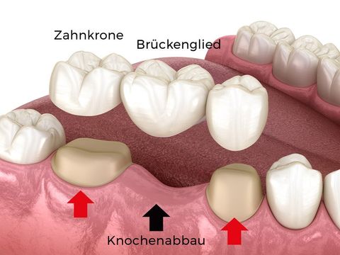 Für eine Zahnbrücke müssen die Nachbarzähne abgeschliffen werden (rote Pfeile). Der Kieferknochen baut sich im Bereich der Zahnlücke ab