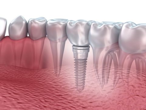 Für den Lückenschluss mit einem Implantat müssen keine Nachbarzähne abgeschliffen werden. Das Implantat minimiert den Knochenabbau.