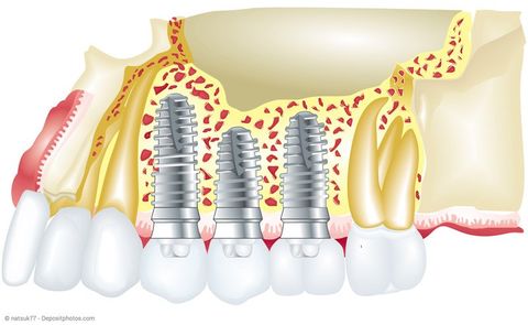 Implantate zum Ersatz fehlender Zähne