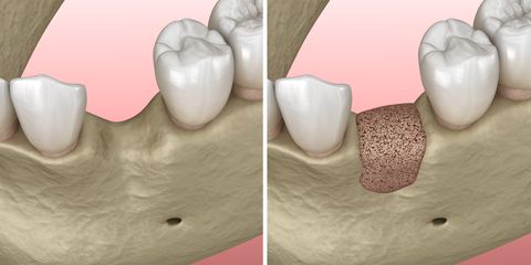 Mit der Socket Preservation wird dem Abbau des Kieferknochens nach Zahnverlust vorgebeugt.