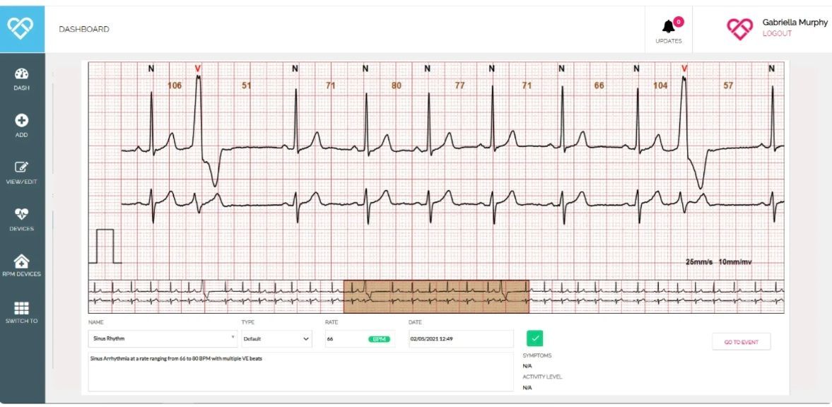 A computer screen shows an ecg of a person 's heartbeat.