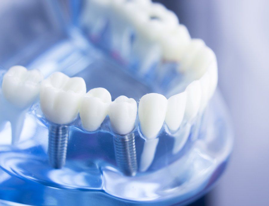 Dental implant services in Steamboat Springs, CO | Dentist