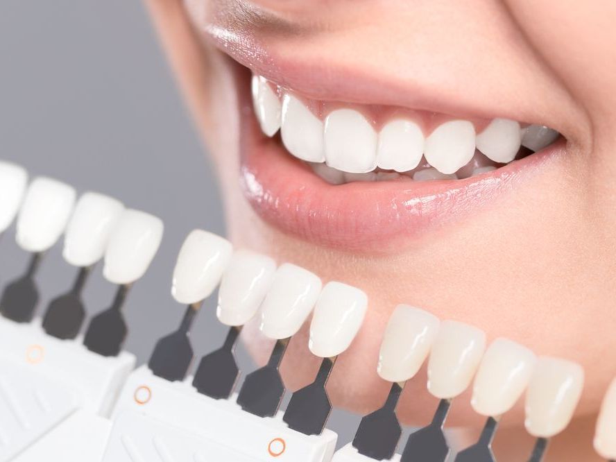 Before and After Teeth Whitening — Cosmetic Clinic in Kiama, NSW